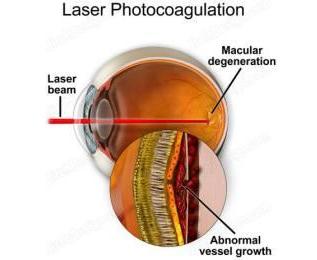 Прижигание сетчатки. Лазерной коагуляции сосудов сетчатки. Дистрофия сетчатки глаза операция лазером. Приваривание лазером отслоившейся сетчатки глаза.
